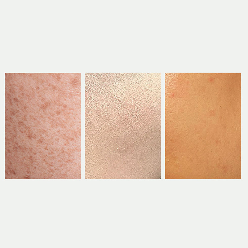 🔥Strålande hudblekning  &  Fläckkorrigerande spray