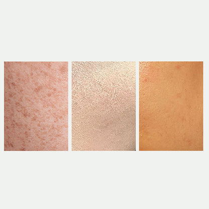 🔥Strålande hudblekning  &  Fläckkorrigerande spray